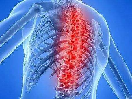 什么是脊柱结核（脊椎结核的症状）